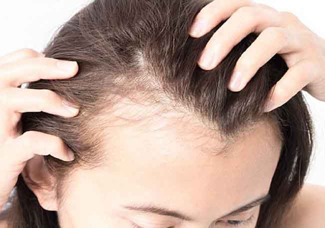 Khi bị rụng tóc cần phải lựa chọn sử dụng sản phẩm dầu gội phù hợp
